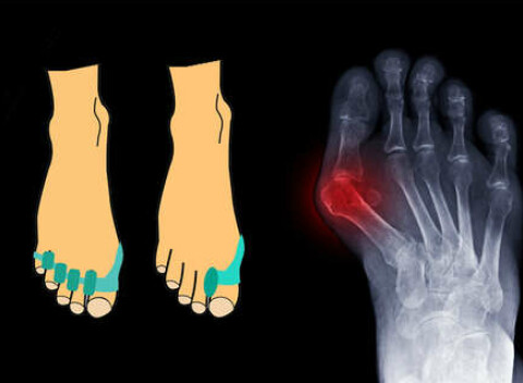 Chránič a korektor vybočených palcov Hallux valgus zo silikónu.