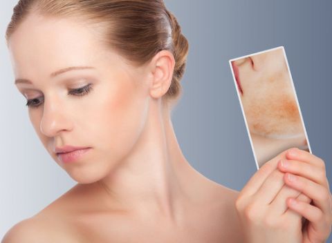 Odstránenie červených žiliek na tvári alebo na tele najmodernejším prístrojom Anife 3D.