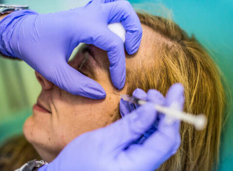 Lekárske vyhladenie vrások vybranej oblasť tváre: výsledok viditeľný 2 – 5 dní po výkone