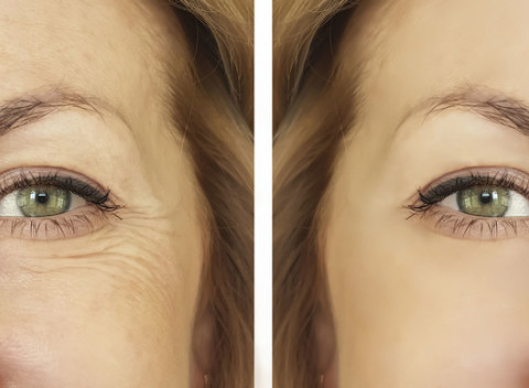 Mezoterapia s okamžitým výsledkom už po prvom zákroku prístrojom Vital Injector.