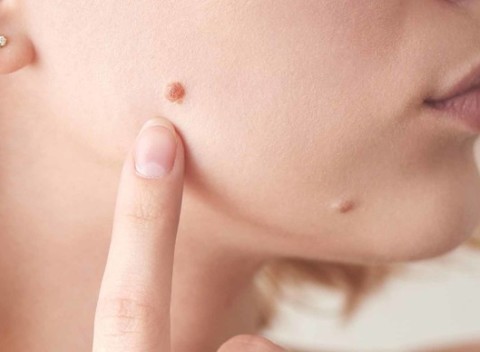 Preventívne dermatoskopické vyšetrenie všetkých materských znamienok na tele.