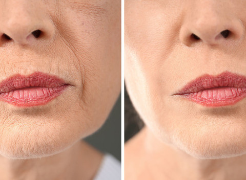 Zabudnite na všetky staré bolestivé metódy. Ultherapia Hifu - facelifting bez skalpela.