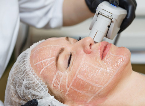 Rozžiarte svoju pleť pomocou novinky Hi-FU - ULTHERY - facelifting ULTHERA terapia.