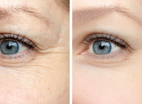 Inovatívna terapia PRX-T33 pre komplexné omladenie pokožky v  Lady štúdio.