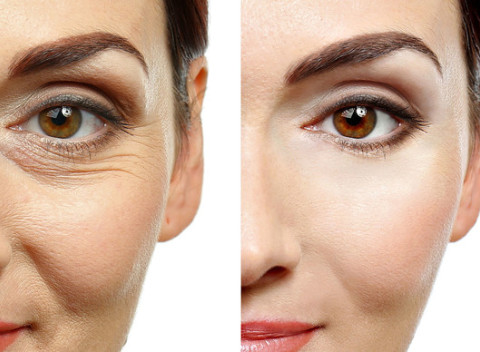Fibroblast - neinvazívny lifting očných viečok a vrások pre žiarivý a mladistvý pohľad.