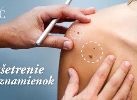 Dôležitá prevencia Dermatoskopické vyšetrenie znamienok