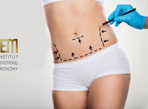 Abdominoplastika – odstránenie previsnutej kože alebo tuku na bruchu.